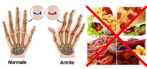 Quali alimenti sono dannosi per l'artrite?